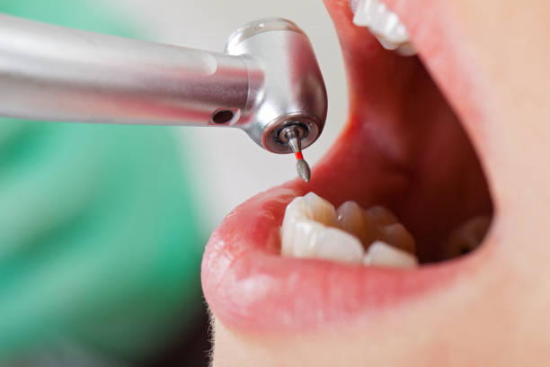 Best Emergency Tooth Extraction in Kearney, MO